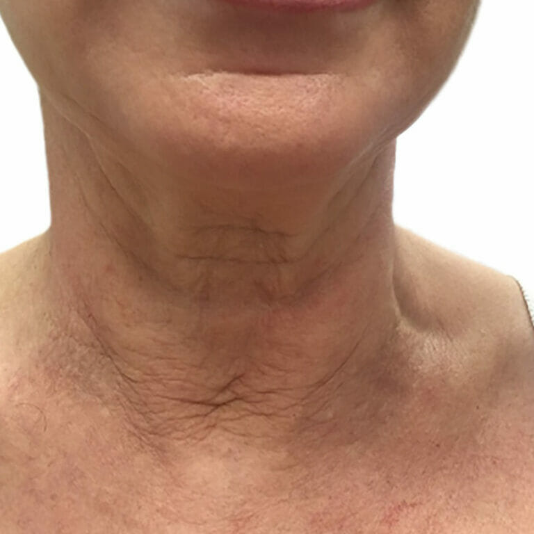 Hautstraffung (HIFU) Perfect Skin Berlin Hautstraffung (HIFU) Perfect Skin Berlin